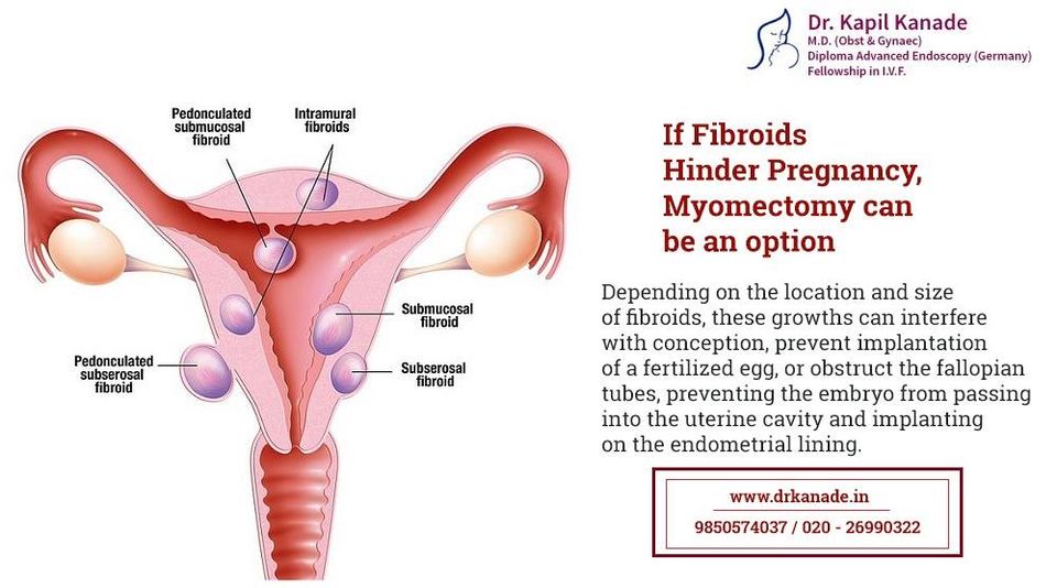 Did you know Fibroids can hinder Pregnancy?